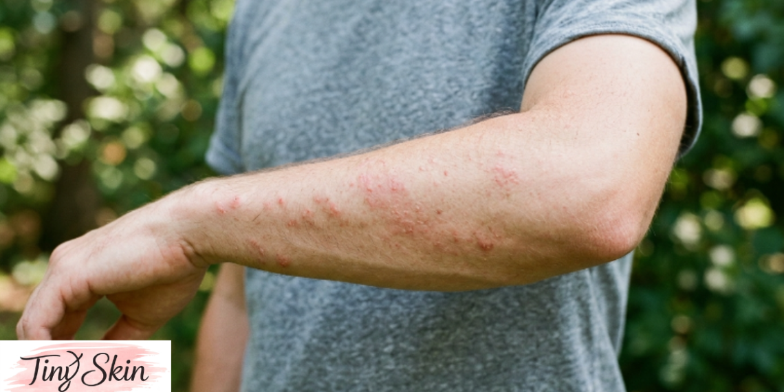 poison ivy rash treatment