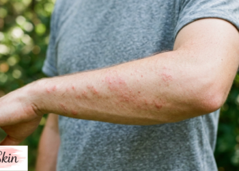 poison ivy rash treatment