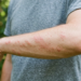 poison ivy rash treatment