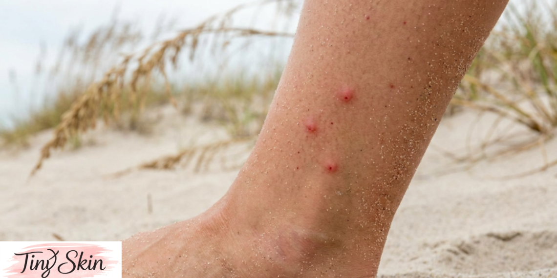 sand flea bites