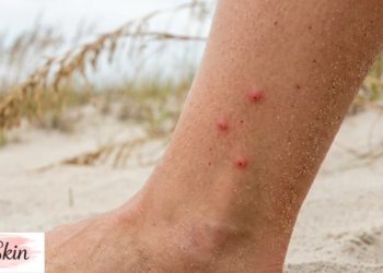 sand flea bites