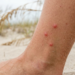 sand flea bites