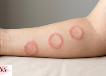 what does ringworm look like