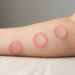 what does ringworm look like