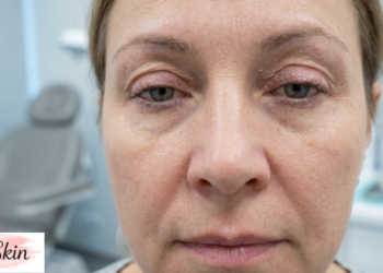 eyelid dermatitis