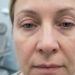 eyelid dermatitis