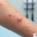 Boils on Skin