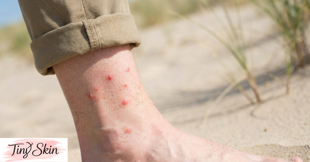 sand flea bites
