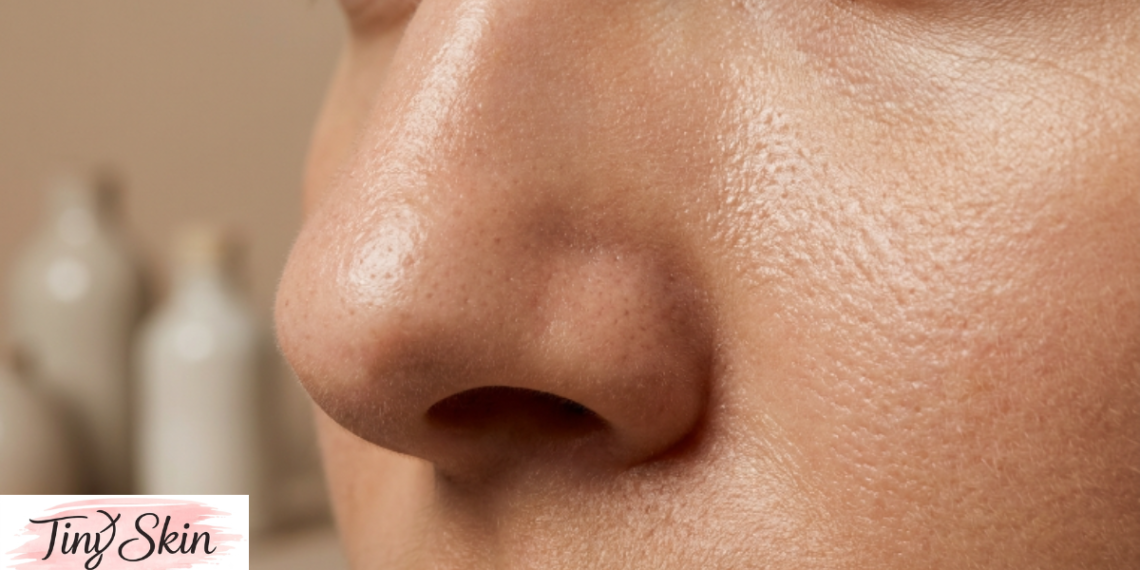 large pores on nose