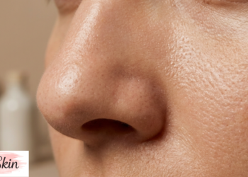 large pores on nose