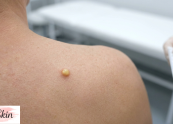 Sebaceous Cyst