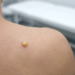 Sebaceous Cyst