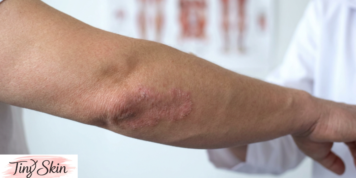 what is psoriasis