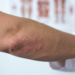 what is psoriasis