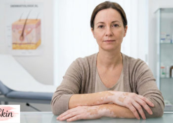what is vitiligo