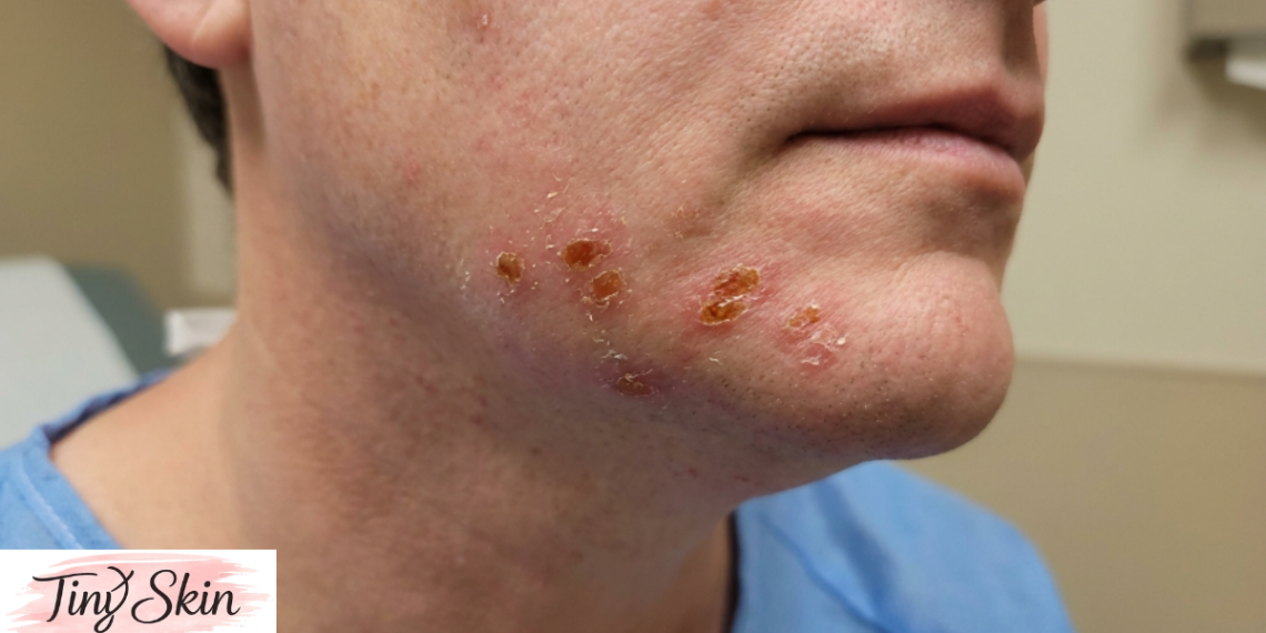 Impetigo Treatment