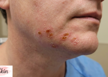 Impetigo Treatment