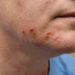 Impetigo Treatment