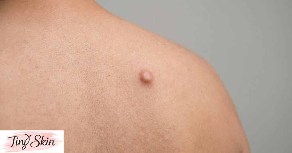 sebaceous cyst removal