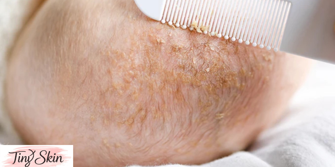 what causes cradle cap