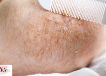 what causes cradle cap