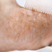 what causes cradle cap