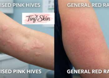 hives vs rash
