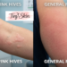 hives vs rash