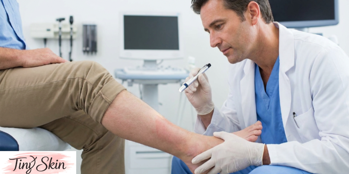 cellulitis treatment