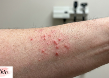 folliculitis