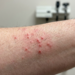 folliculitis