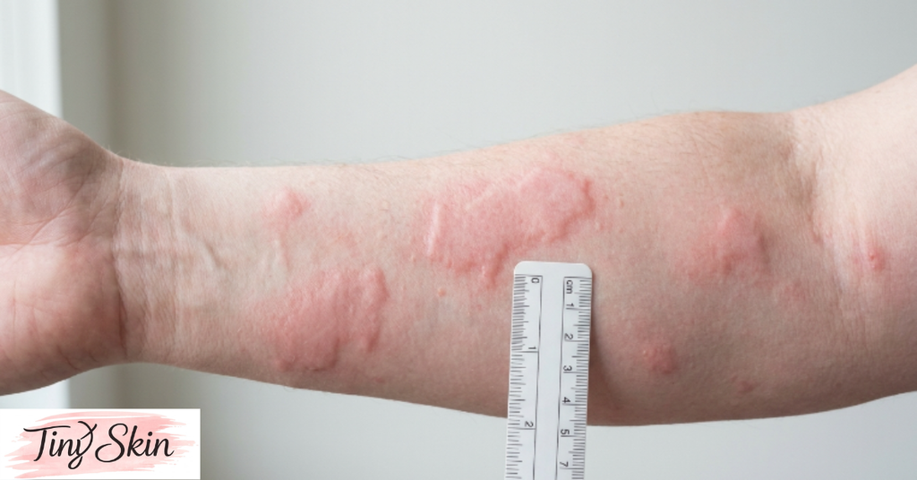 hives vs rash