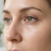 how to get rid of dark circles under eyes