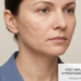 post inflammatory hyperpigmentation