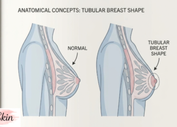 Tubular Breasts