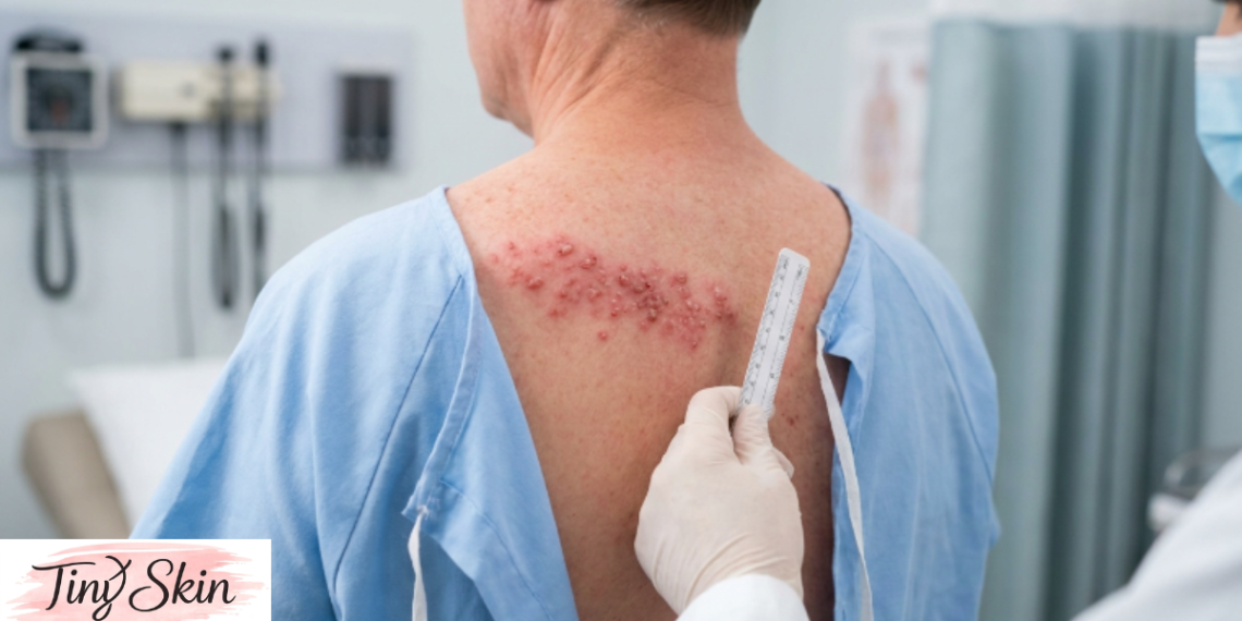 shingles rash