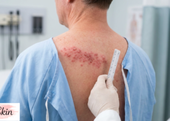 shingles rash