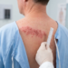 shingles rash