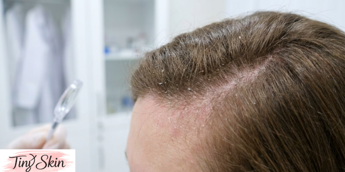 seborrheic dermatitis scalp