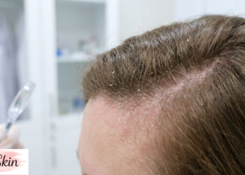 seborrheic dermatitis scalp