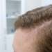 seborrheic dermatitis scalp