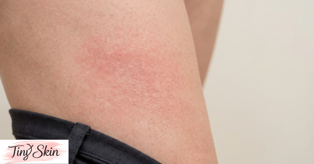 how to treat chafing in groin area female